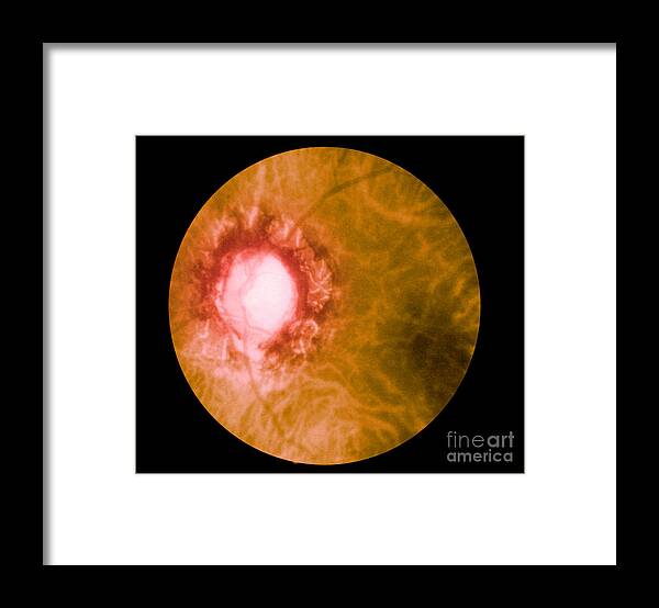 Bacteria Framed Print featuring the photograph Retina Infected By Syphilis by Science Source