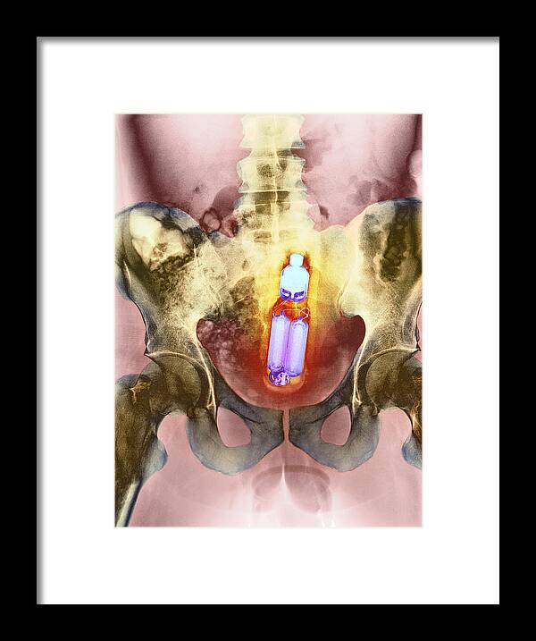 Sex Toy In Man S Rectum X Ray Framed Print By Du Cane Medical Imaging Ltd