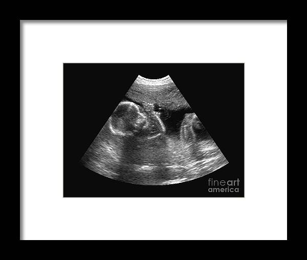 Skuffelse Derfor slump Ultrasound Of Fetus Framed Print by Medical Body Scans - Pixels
