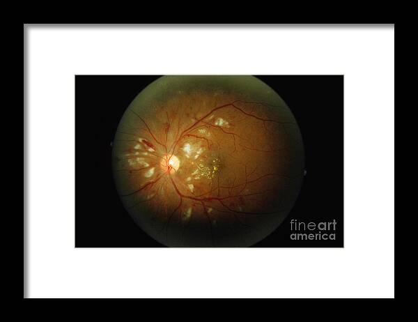 Blood Vessels Framed Print featuring the photograph Cmv Retinitis #1 by Science Source