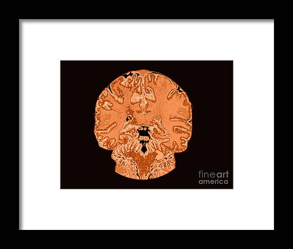 Brain Framed Print featuring the Coronal View Mri Of Normal Brain #3 by Medical Body Scans