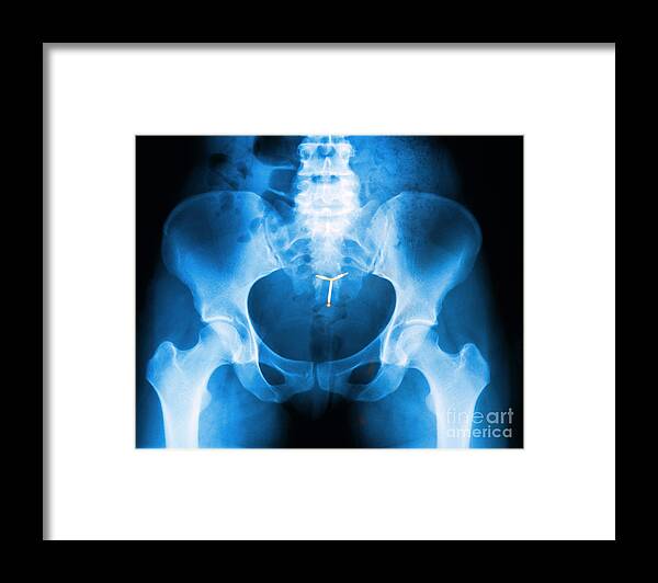 Birth Control Framed Print featuring the photograph Iud Contraceptive, X-ray by George Mattei