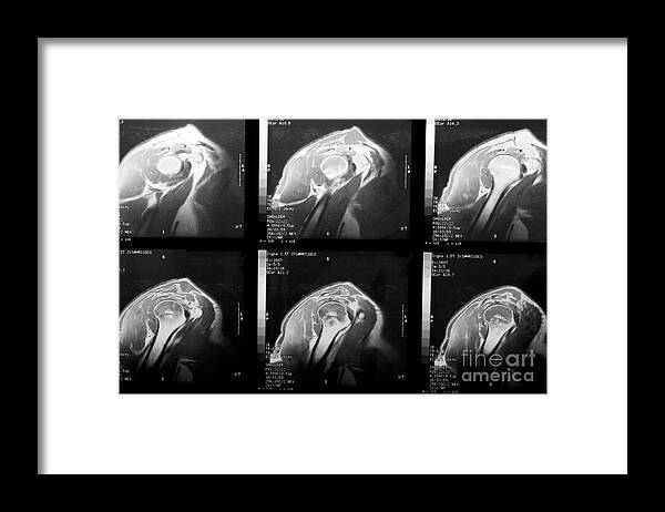 Rotator Cuff Framed Print featuring the photograph MRI of Rotator Cuff by Karen Foley