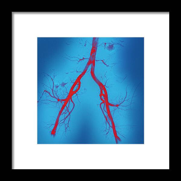 Iliac Framed Print featuring the photograph Normal Abdominal Arteries, Angiogram by Miriam Maslo