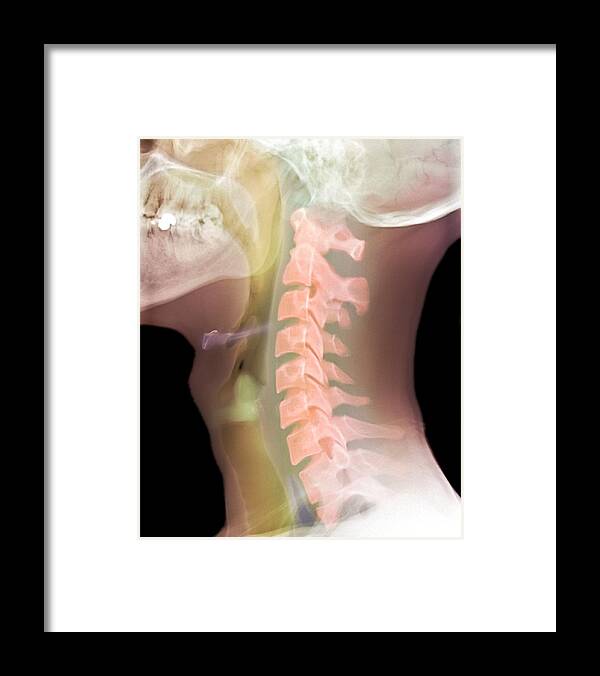 Neck Framed Print featuring the photograph Normal Neck, X-ray by Du Cane Medical Imaging Ltd