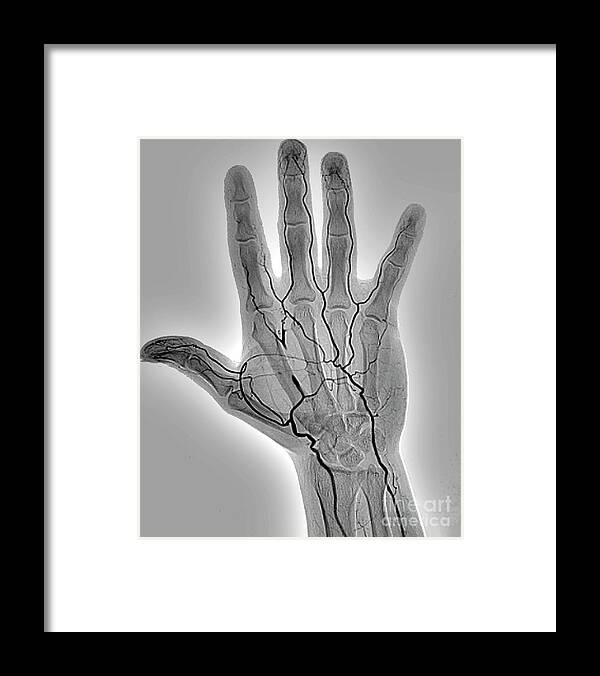 50s Framed Print featuring the photograph Blocked Hand Artery #1 by Zephyr/science Photo Library