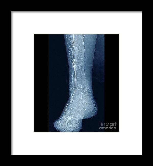 70s Framed Print featuring the photograph Blocked Leg Artery #1 by Zephyr/science Photo Library