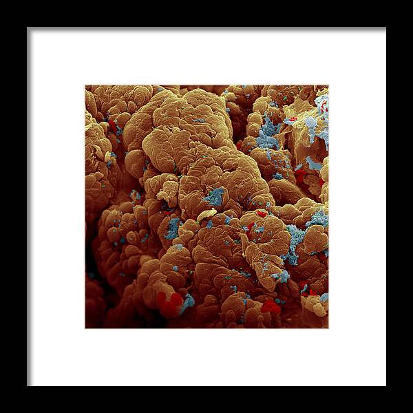 Cancer Framed Print featuring the photograph Colon Cancer #1 by Meckes/ottawa