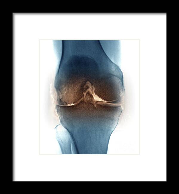 58 Framed Print featuring the photograph Osteoarthritis Of The Knee Joint #1 by Zephyr/science Photo Library