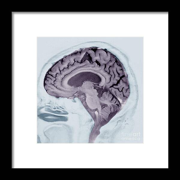 Alzheimer's Disease Framed Print featuring the photograph Alzheimer's Disease #13 by Zephyr/science Photo Library