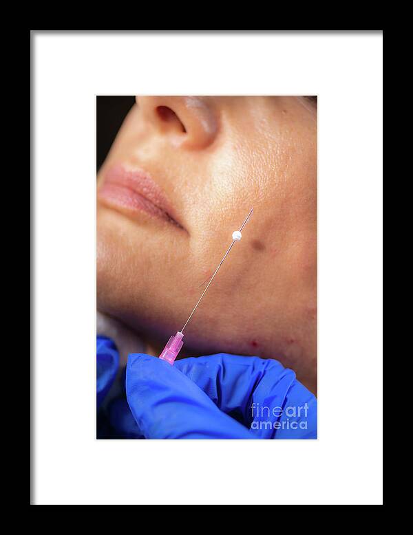 Facelift Framed Print featuring the photograph Mesotherapy Thread Face Lift Procedure #16 by Microgen Images/science Photo Library