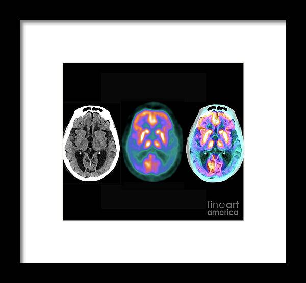 Alzheimer's Disease Framed Print featuring the photograph Alzheimer's Disease #17 by Zephyr/science Photo Library