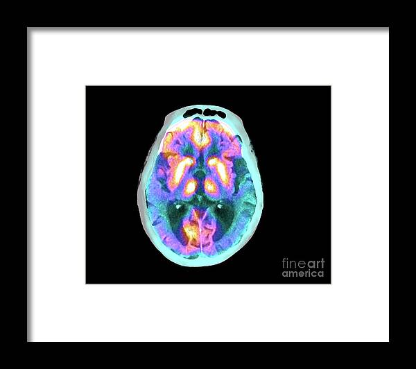 Alzheimer's Disease Framed Print featuring the photograph Alzheimer's Disease #22 by Zephyr/science Photo Library