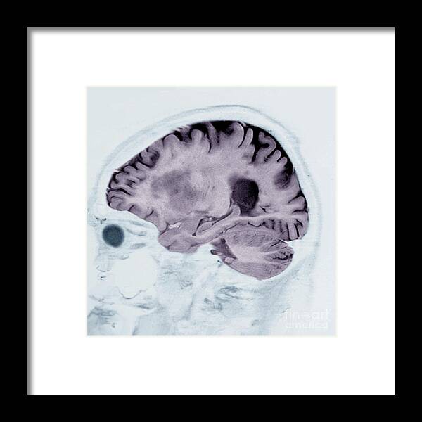 Alzheimer's Disease Framed Print featuring the photograph Alzheimer's Disease #26 by Zephyr/science Photo Library