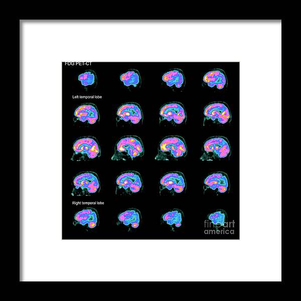 Alzheimer's Disease Framed Print featuring the photograph Alzheimer's Disease #28 by Zephyr/science Photo Library