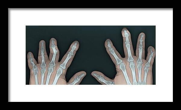Abnormal Framed Print featuring the photograph Psoriatic Arthritis, X-ray #3 by Steven Needell