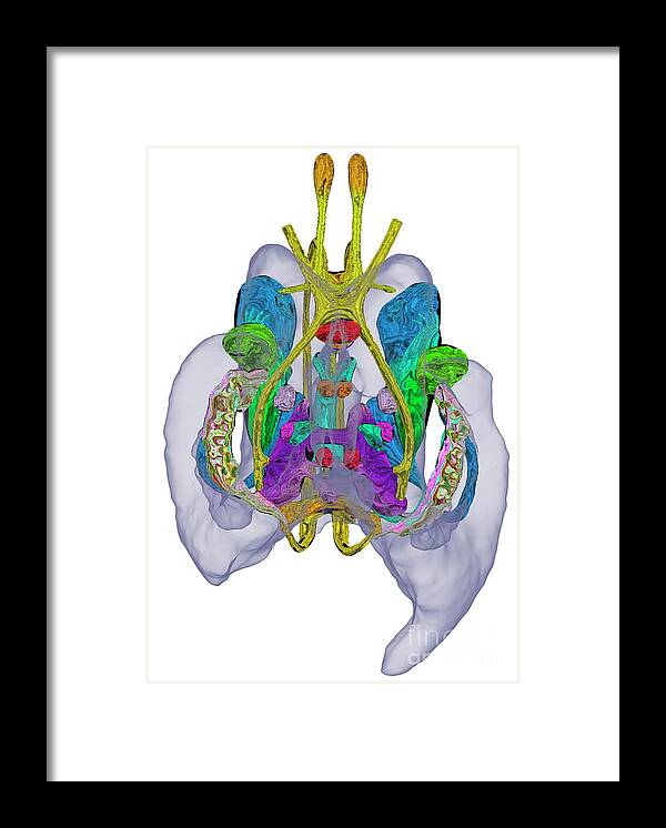 3d Framed Print featuring the photograph Limbic System In Alzheimer's Disease #5 by K H Fung/science Photo Library