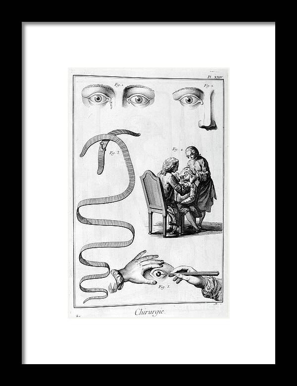 Engraving Framed Print featuring the drawing Eye Surgery, 1751-1777 by Print Collector