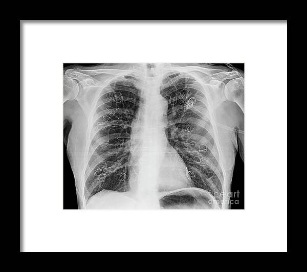 Lung Volume Reduction Framed Print featuring the photograph Implanted Lung Volume Reduction Coils by Science Photo Library