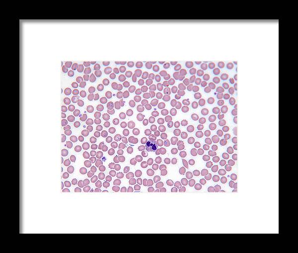 White Background Framed Print featuring the photograph Malarial Blood Cells by michael J. Klein, M.d.