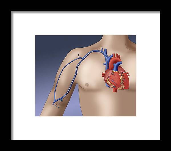 Catheter Framed Print featuring the photograph Picc Intravenous Device, Illustration by Monica Schroeder