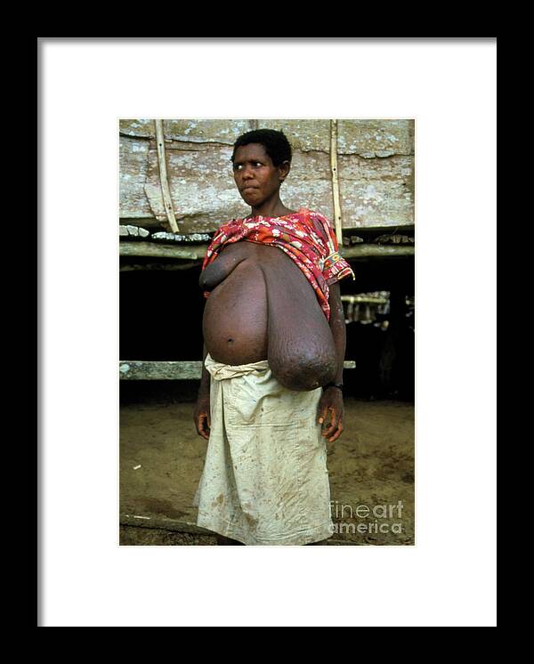 Woman with a breast enlarged by elephantiasis - Stock Image - M160