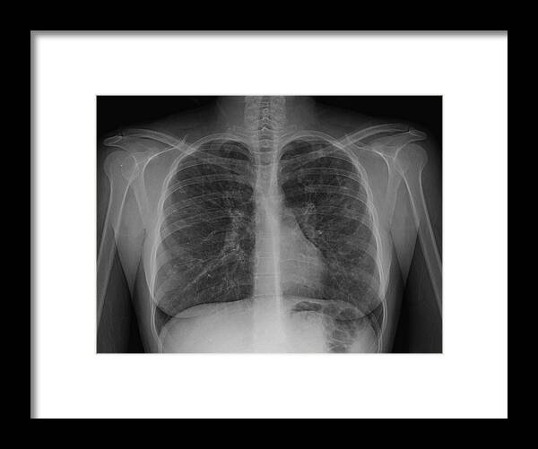 Problems Framed Print featuring the photograph X-ray of chest showing cystic fibrosis by Callista Images
