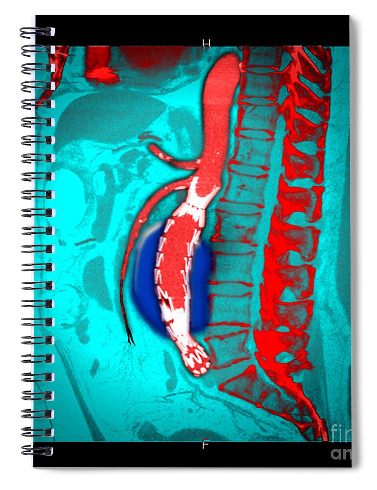 Science Spiral Notebook featuring the photograph Abdominal Stent Graft #1 by Living Art Enterprises