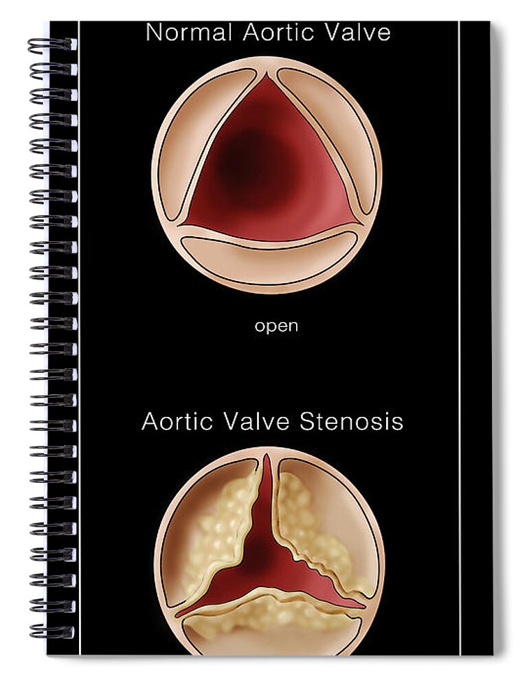 Illustration Spiral Notebook featuring the photograph Aortic Valve, Normal & Stenosis #1 by Monica Schroeder