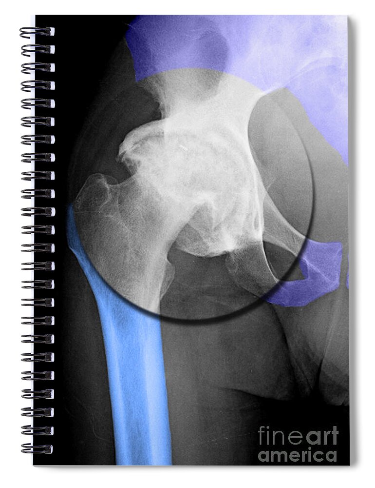 Arthritis Spiral Notebook featuring the photograph Arthritic Hip #1 by Living Art Enterprises, LLC