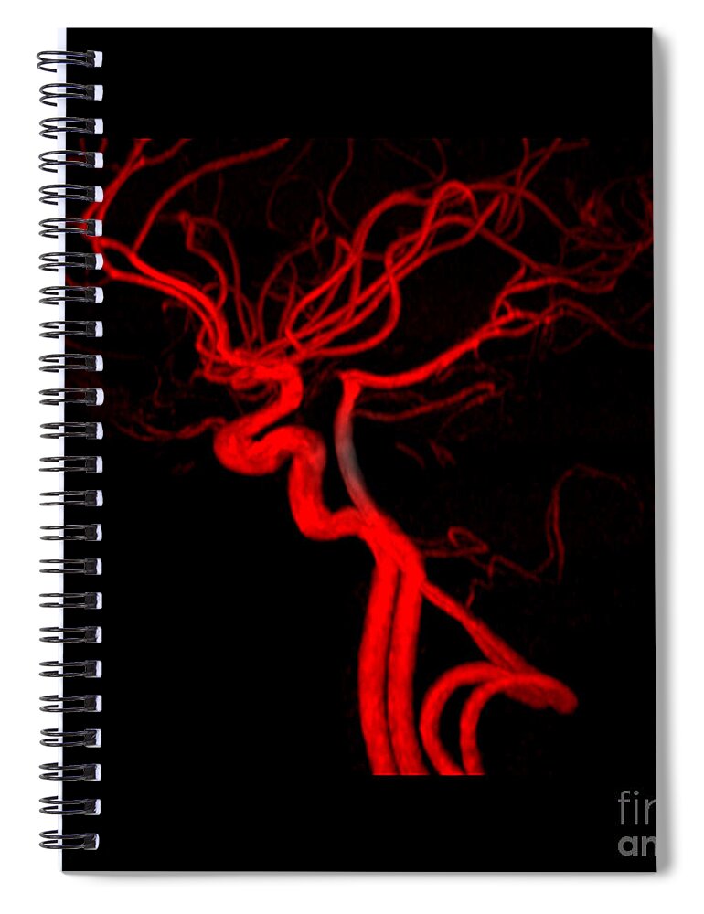 Intracranial Mra Spiral Notebook featuring the photograph Normal Intracranial Mra #2 by Living Art Enterprises