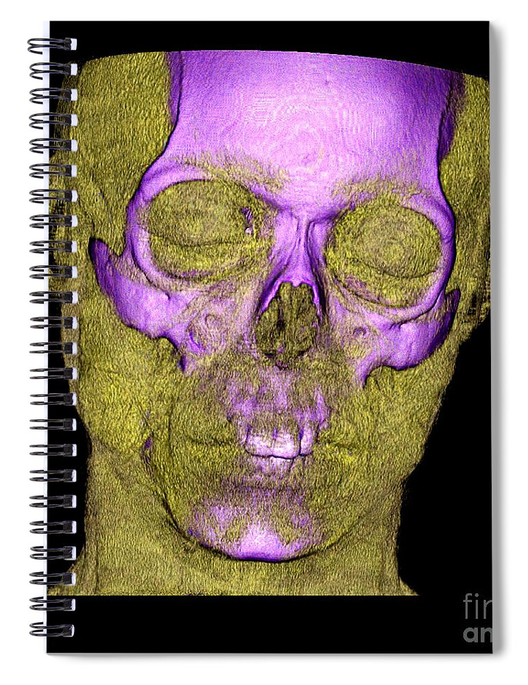 Science Spiral Notebook featuring the photograph Enhanced 3d Ct Of Face And Skull #3 by Living Art Enterprises
