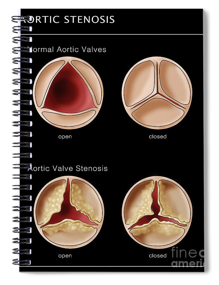 Illustration Spiral Notebook featuring the photograph Aortic Valve, Normal & Stenosis by Monica Schroeder