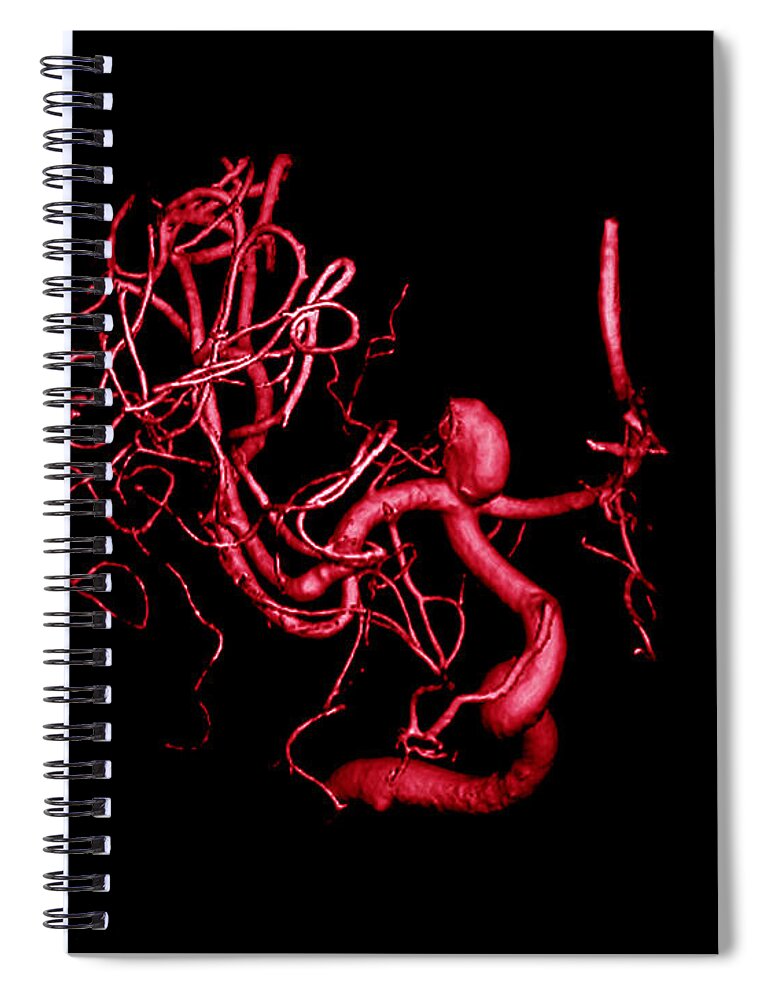 Cerebral Angiogram Spiral Notebook featuring the photograph Cerebral Aneurysm, 3d Scan by Living Art Enterprises