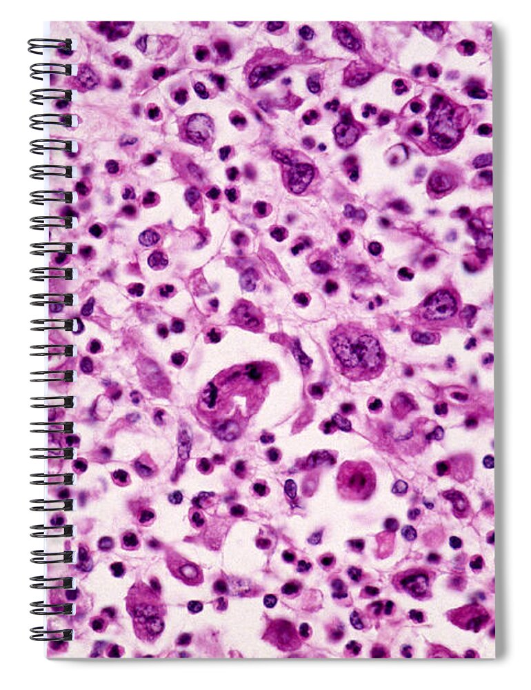 Abnormal Spiral Notebook featuring the photograph Giant-cell Carcinoma Of The Lung, Lm by Michael Abbey