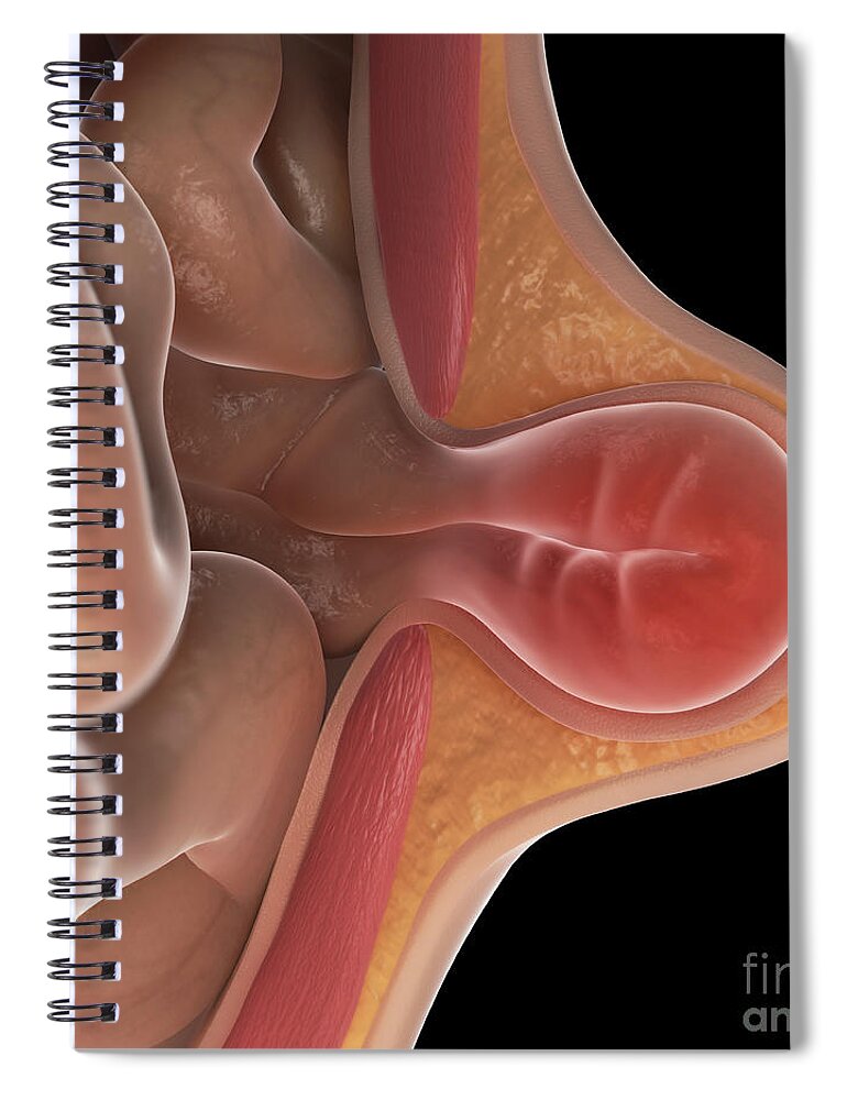 Problematic Spiral Notebook featuring the photograph Hernia Cross-section by Science Picture Co