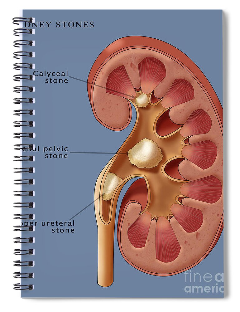 Kidney Spiral Notebook featuring the photograph Kidney Stones, Illustration by Monica Schroeder