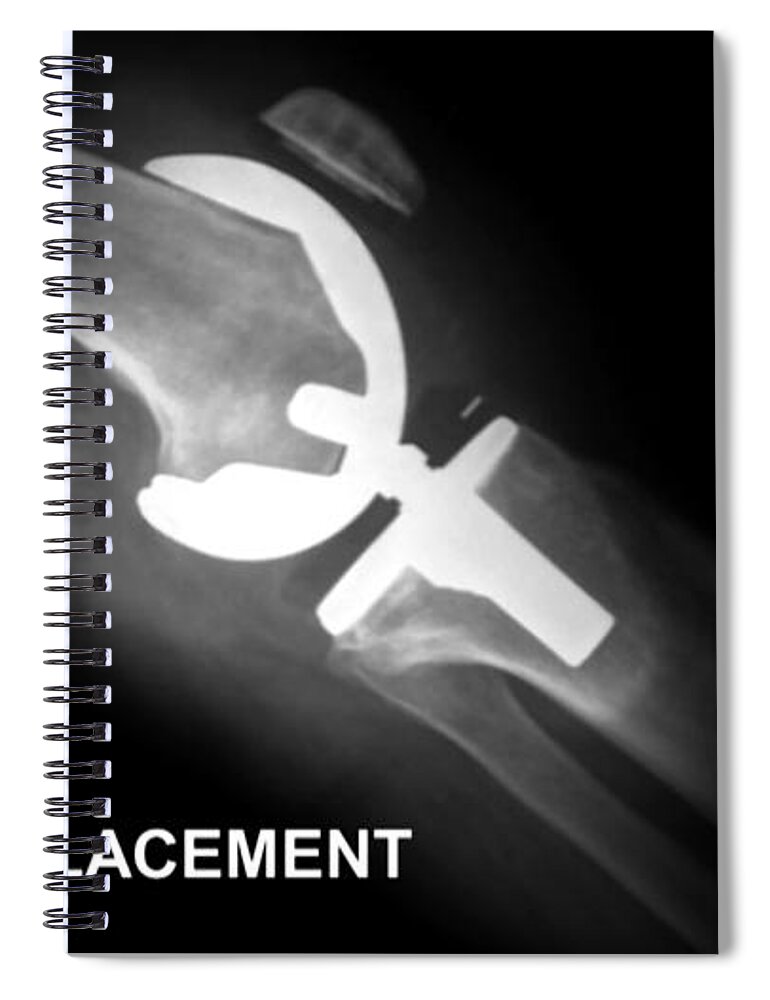 Anatomy Spiral Notebook featuring the photograph Knee Replacement, X-ray by Anatomical Travelogue