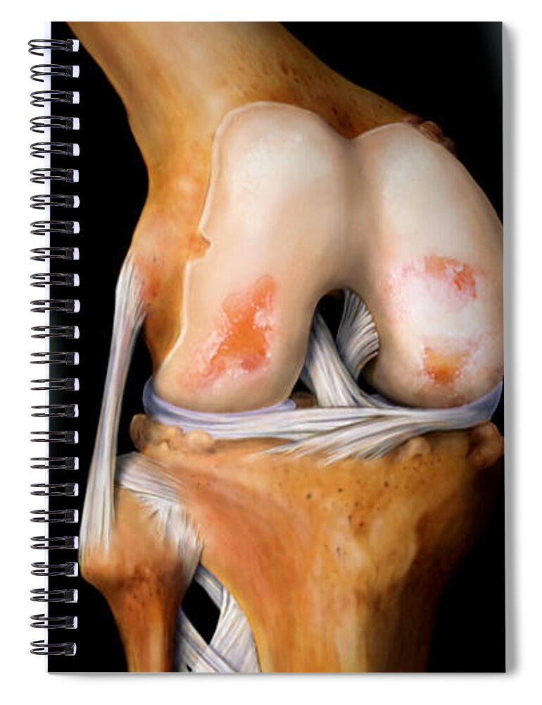 Abnormal Spiral Notebook featuring the photograph Knee With Arthritis, 3 Of 4 by Anatomical Travelogue