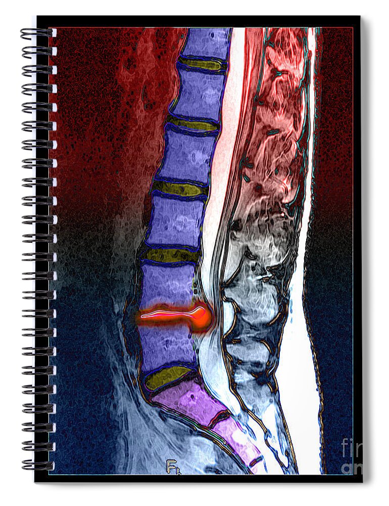 Mri Spiral Notebook featuring the photograph Lumbar Disc Hernation, Mri by Living Art Enterprises