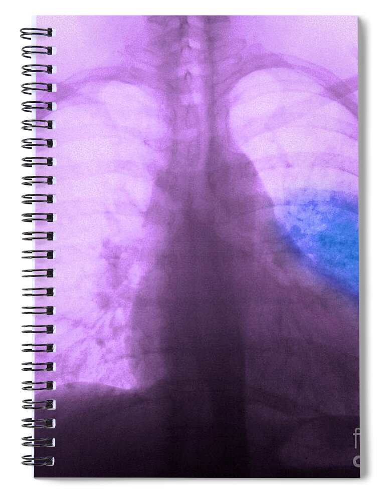 X Ray Spiral Notebook featuring the photograph Pneumonia, X Ray by Scott Camazine