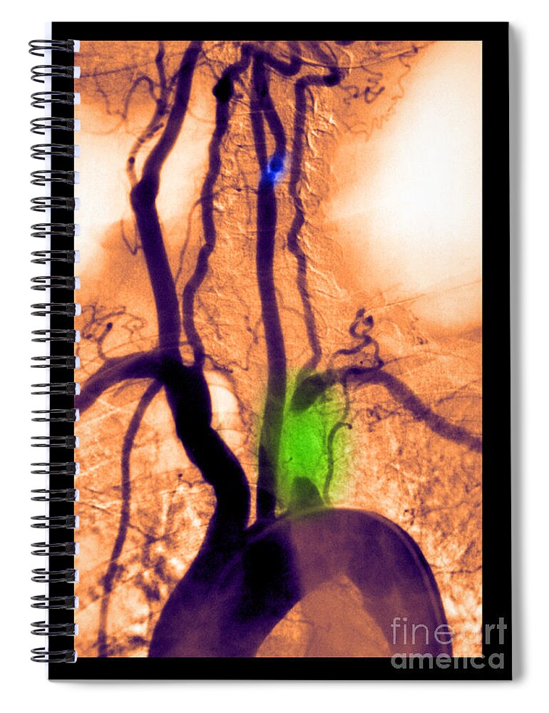 Abnormal Angiogram Spiral Notebook featuring the photograph Aortic Arch Angiogram #2 by Medical Body Scans