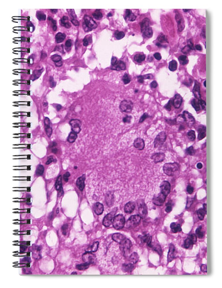 Science Spiral Notebook featuring the photograph Mycobacterial Skin Infection #2 by Science Source