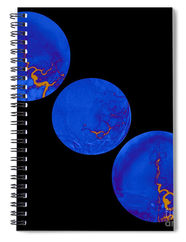 Angiogram Of Stroke Spiral Notebook featuring the photograph Stroke Treatment #3 by Medical Body Scans