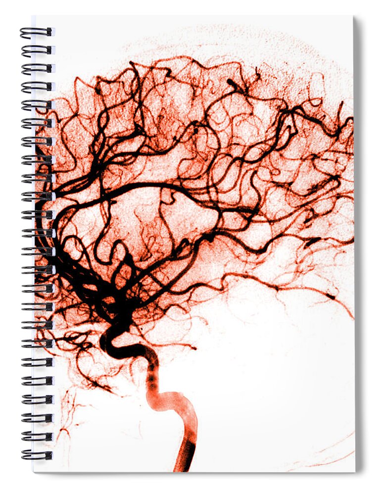 Catheter Cerebral Angiogram Spiral Notebook featuring the photograph Cerebral Angiogram by Medical Body Scans