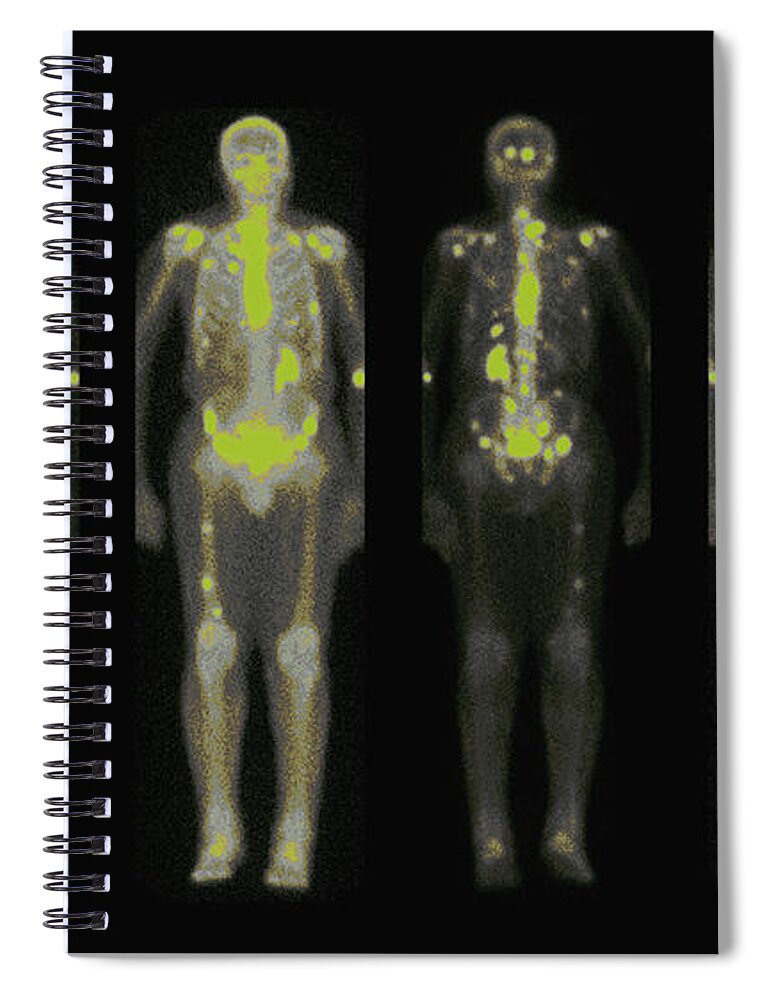 Bone Spiral Notebook featuring the photograph Nuclear Medicine Bone Scan #5 by Medical Body Scans