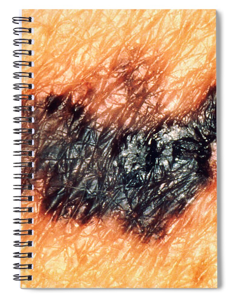 Melanoma Spiral Notebook featuring the photograph Melanoma #7 by Science Source