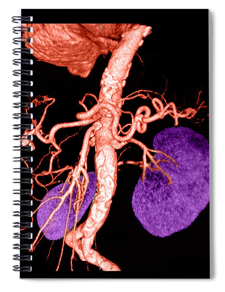 3 Dimensional Spiral Notebook featuring the photograph Abdominal Aorta #8 by Medical Body Scans