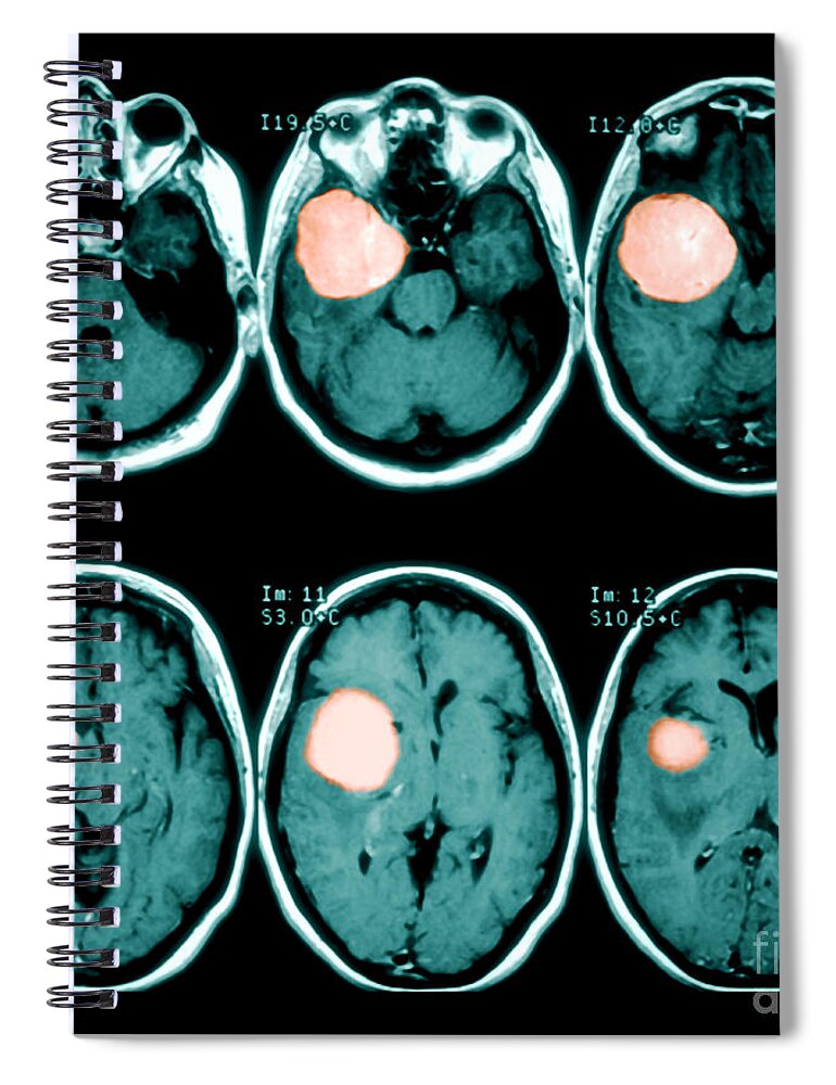 Mri Spiral Notebook featuring the photograph Brain Tumor by Medical Body Scans