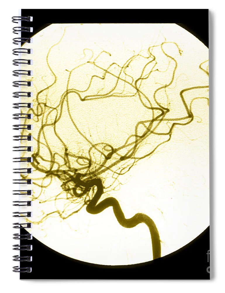 Cerebral Angiogram Spiral Notebook featuring the photograph Internal Carotid Cerebral Angiogram by Medical Body Scans
